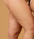 Celulitis