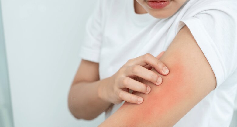 Sarpullido en la piel por calor y sudor: causas y alivio