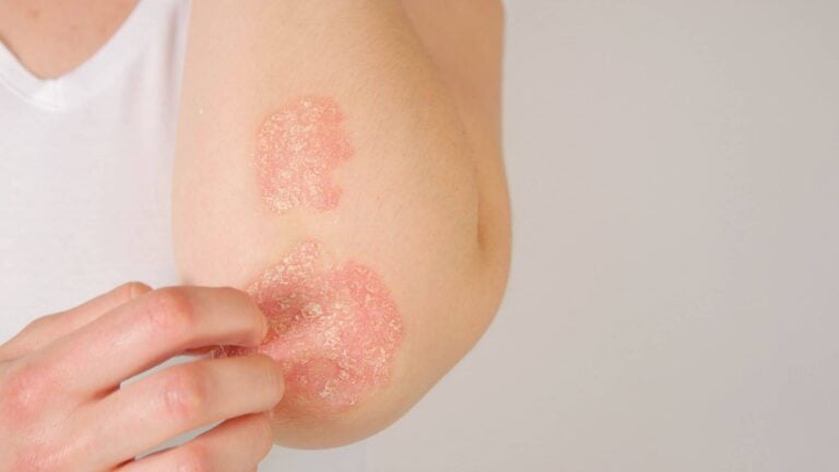 como mejorar la piel con psoriasis atopica