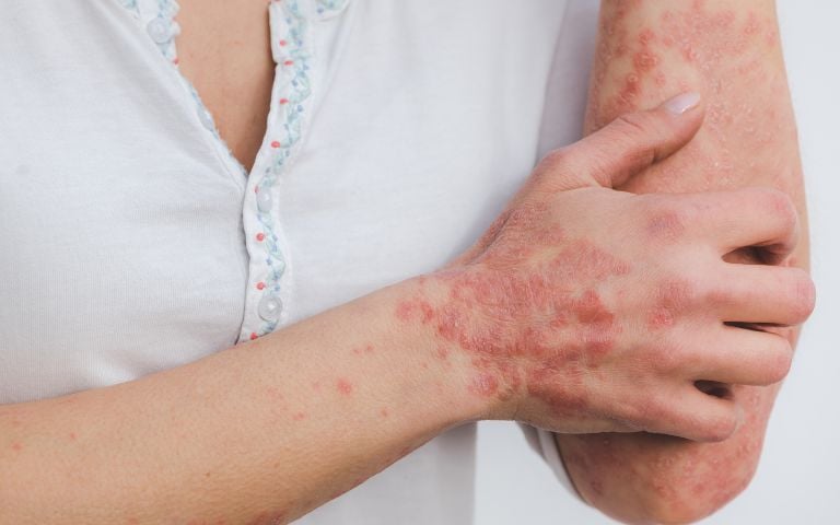 cómo mejorar la piel atopica psoriasis