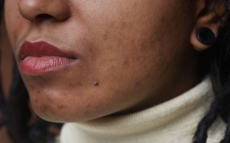 Manchas oscuras en la piel: te contamos sus causas y cómo tratarlas