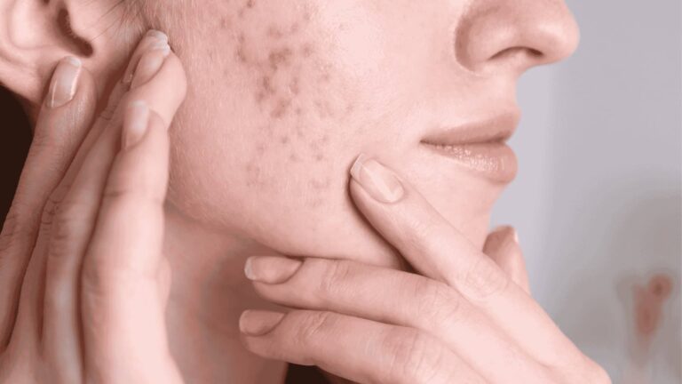 Cómo mejorar la piel con acné