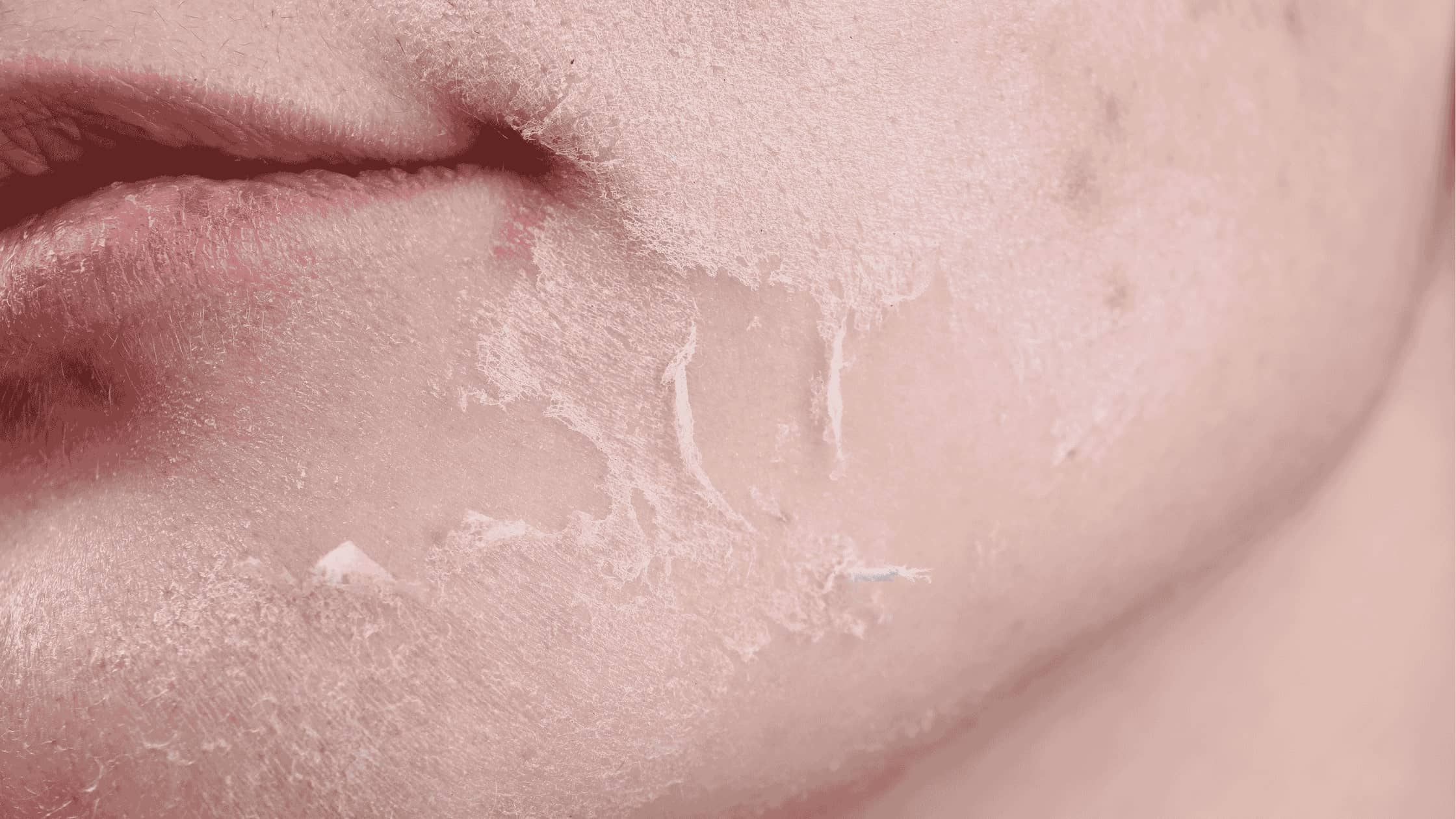 como mejorar la piel sensible