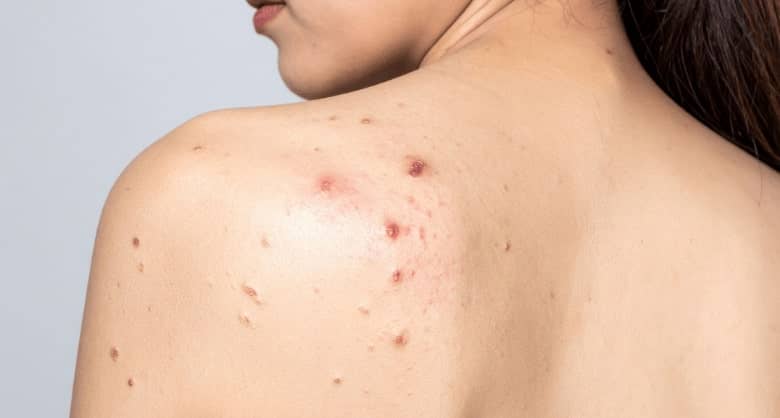 Cómo mejorar la piel con acné