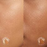 Antes-Despues Mawanga35 CC CREAM