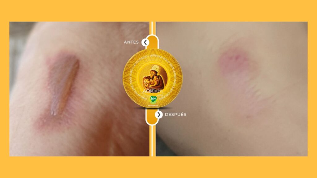 quemaduras manteca karité