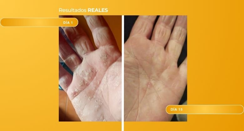 quemaduras manteca karite