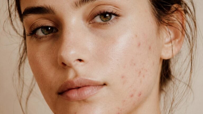 acne adulto