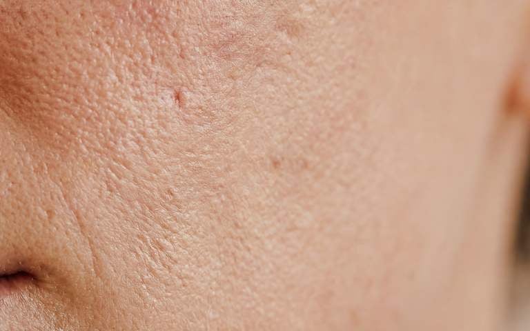 acne adulto