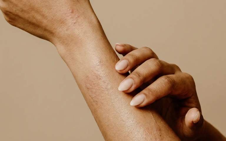 manteca de karité dermatitis