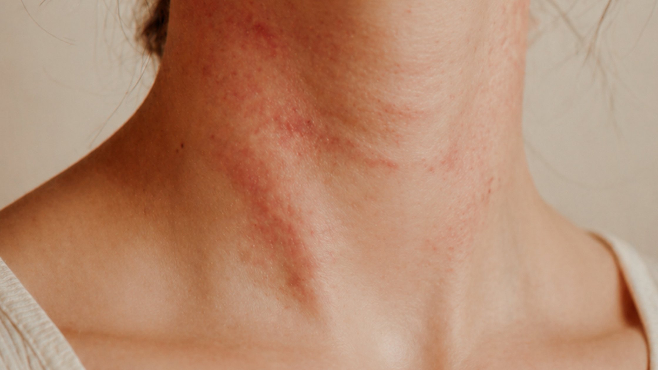 manteca de karité dermatitis