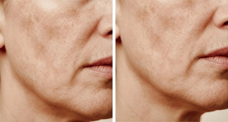Crema para flacidez y descolgamiento facial